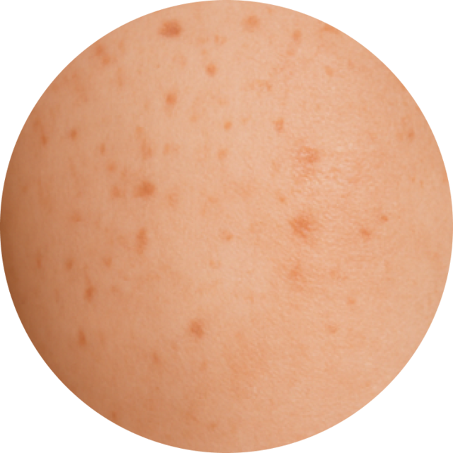 표피성 색소 질환