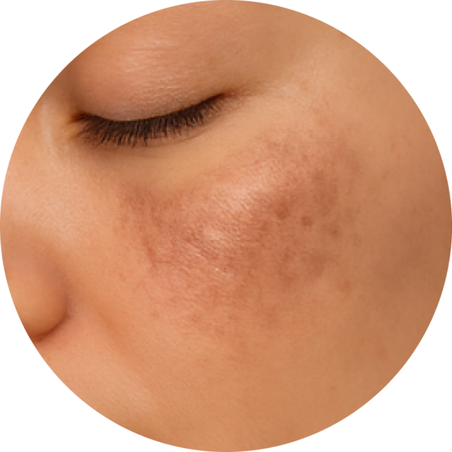 진피성 색소 질환